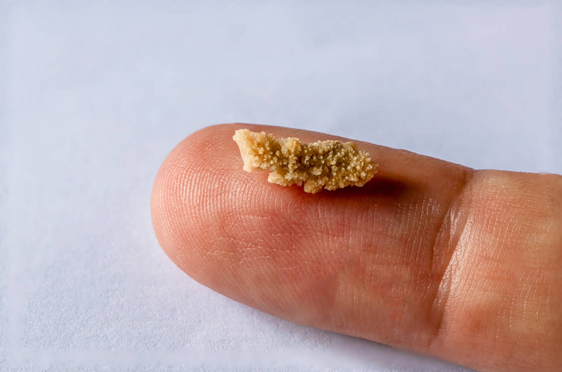 Die meisten Nierensteine haben einen kleineren Durchmesser als 5 mm und werden von selbst ausgeschieden. Größere Steine können durch Stoßwellen zertrtümmert oder operativ entfernt werden. / © Getty Images/Ernesto r. Ageitos