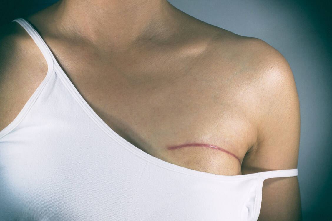 Die Behandlung von Brustkrebs kann viele Folgeschäden auslösen. Einer davon ist Osteoporose – je nach Intensität der Therapie auch bei prämenopausalen Frauen. / Foto: iStock/Pradit_Ph