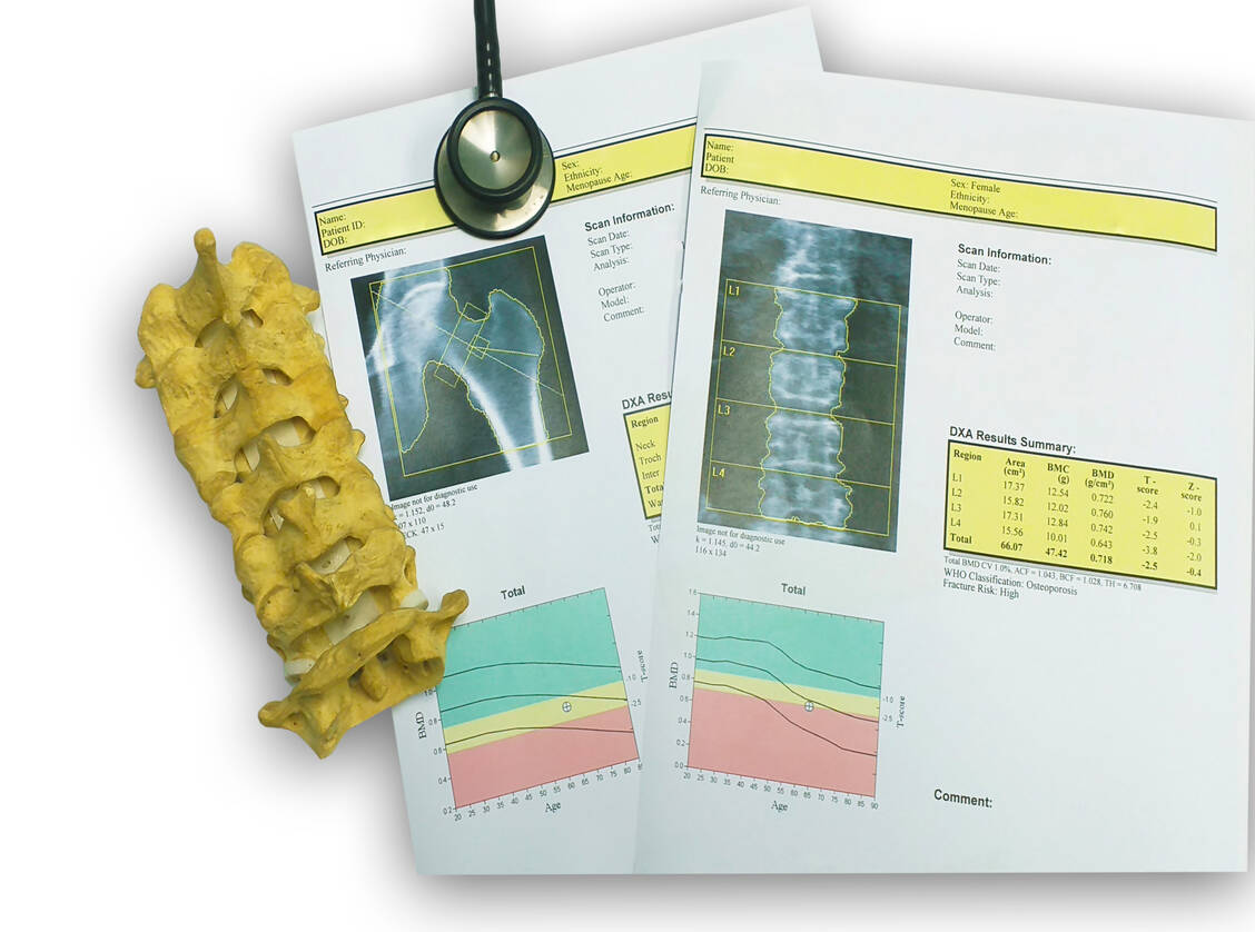 Osteoporose-Patienten haben alle fünf Jahre Anspruch auf eine Knochendichtemessung als Kassenleistung. / © shutterstock/April stock