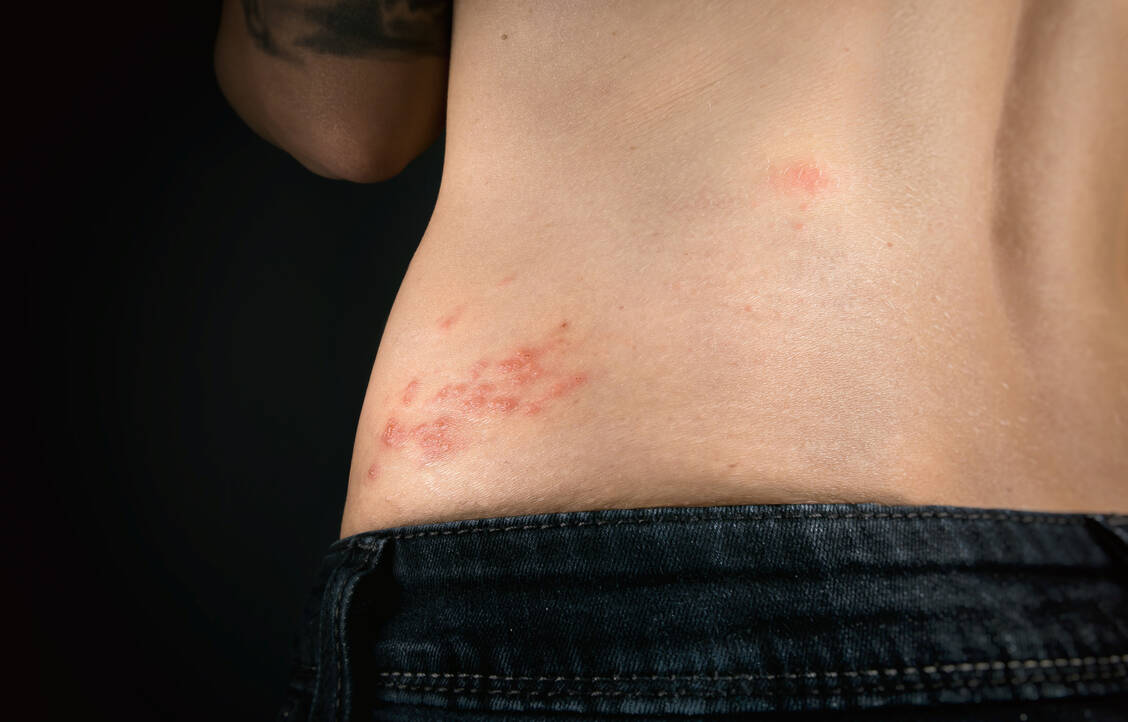 Kann die Covid-19-Impfung die Reaktivierung des Varizella-Zoster-Virus und damit eine Gürtelrose auslösen? Die Datenlage spricht gegen einen kausalen Zusammenhang. / Foto: Getty Images/Petra Richli