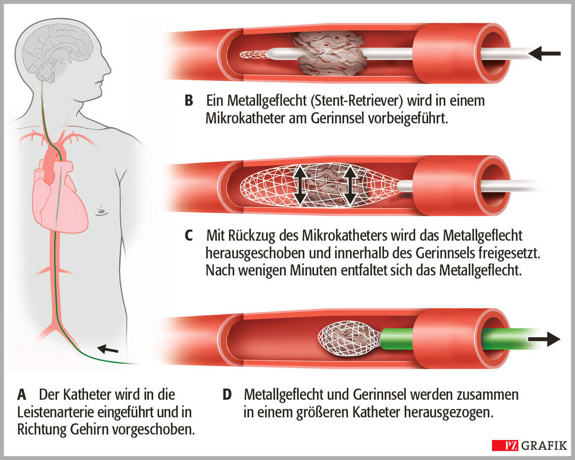Grafik 2: Bei der Thrombektomie entfernen Neuroradiologen das Gerinnsel mittels minimalinvasiver Katheterverfahren. Damit wird die Hirndurchblutung wiederhergestellt. / Foto: PZ/Stephan Spitzer