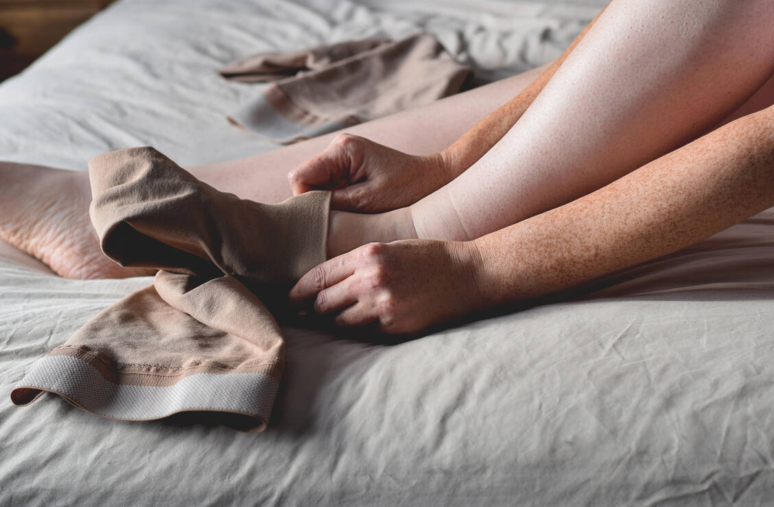 Bei venöser Insuffizienz gilt die Kompression als Basistherapie, doch sie ist bei den meisten Patienten nicht beliebt. / Foto: Adobe Stock/Julia