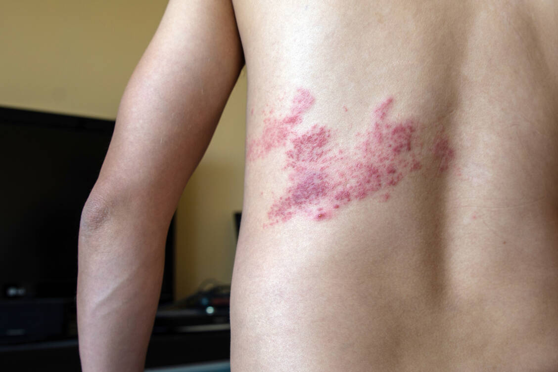 Herpes-zoster-Läsionen bilden sich in der Regel einseitig und verlaufen nicht über die Mittellinie des Körpers. / © Shutterstock/Trybex