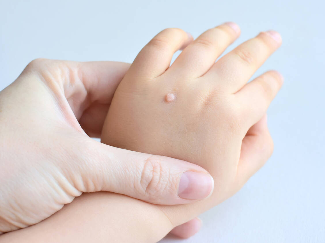 Aufgrund ihrer noch nicht voll ausgebildeten Immunität sind Kinder sehr viel häufiger als Erwachsene von Warzen betroffen. / Foto: Adobe Stock/Tanya Ivanova