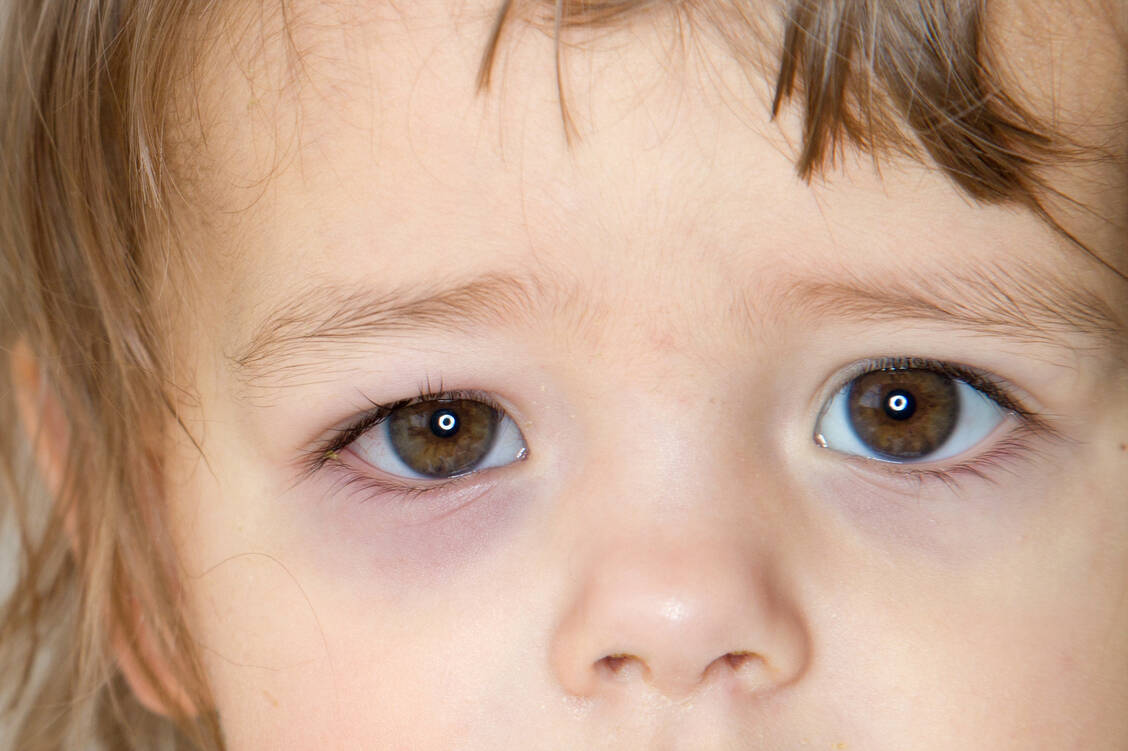 Ein rotes tränendes Auge kann viele Ursachen haben. Eher harmlos sind kleine Verletzungen durch ein Insekt oder eine Wimper auf dem Augapfel. / Foto: Adobe Stock/lavizzara