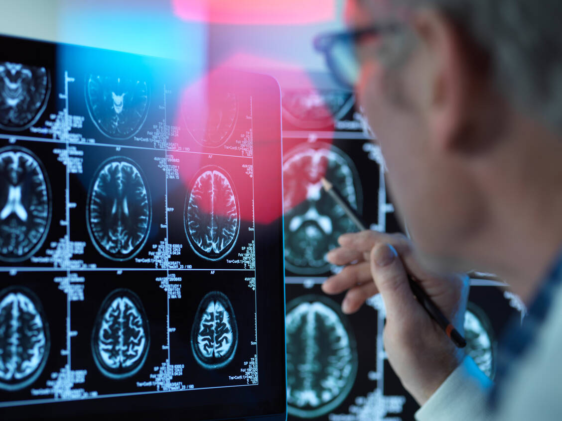 Auffälligkeiten im MRT (ARIA) sind eine mögliche Nebenwirkung des Alzheimer-Antikörpers Lecanemab. Für bestimmte Patienten, die ein besonders hohes Risiko für ARIA haben, soll der Wirkstoff daher in der EU nicht zugelassen werden. / © Getty Images/Andrew Brookes