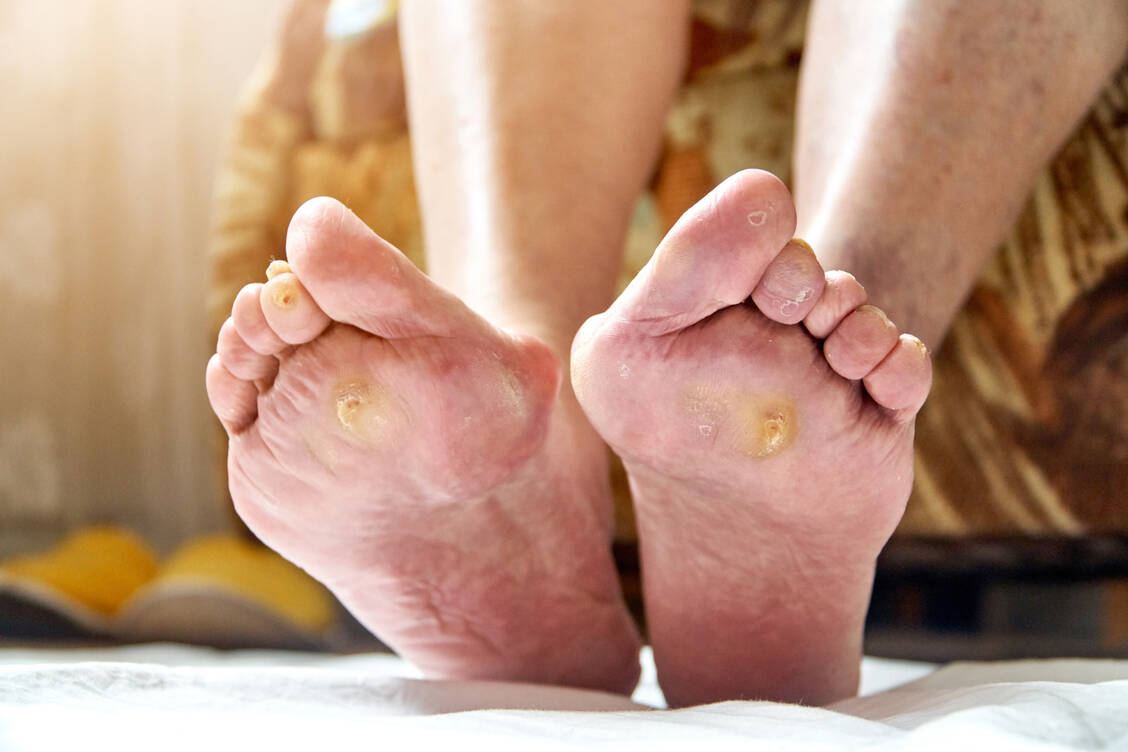 Empfindliche Füße: Langjähriger Diabetes und Polyneuropathie belasten die Füße massiv. Hornhaut, Blasen, Geschwüre und schlimmstenfalls Knochenbrüche gehören zum Bild des diabetischen Fußsyndroms. / Foto: Adobe Stock/troyanphoto