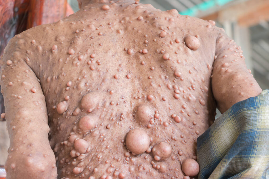 Bindegewebige Hautveränderungen sind ein charakteristisches Merkmal der Neurofibromatose. / Foto: Shutterstock/CHIEW