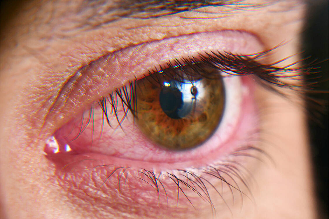 Bei bakteriellen Infektionen des Auges wird oft Gentamicin gegeben, bei starker Entzündung gerne in Kombination mit Dexamethason. / Foto: Adobe Stock/Kryuchka Yaroslav