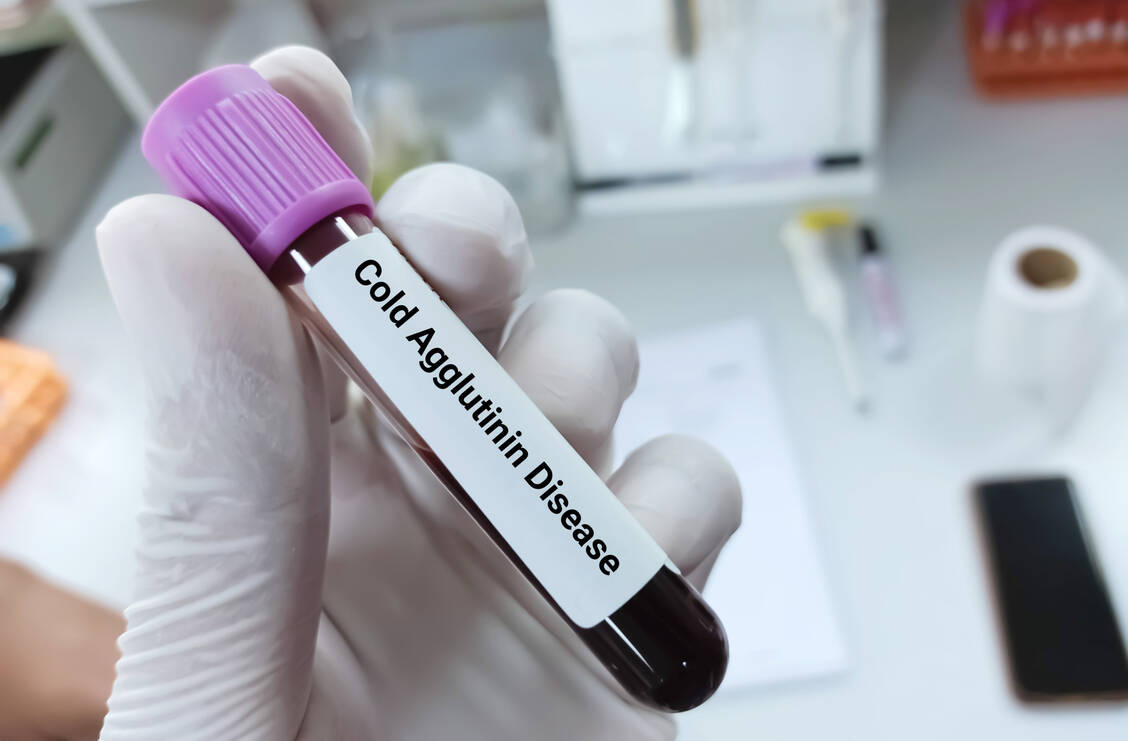 Bei der seltenen Kälteagglutinin-Krankheit attackiert das Kom­plementsystem die Erythrozyten und es kommt zur hämolytischen Anämie. / Foto: Adobe Stock/Innovative Creation