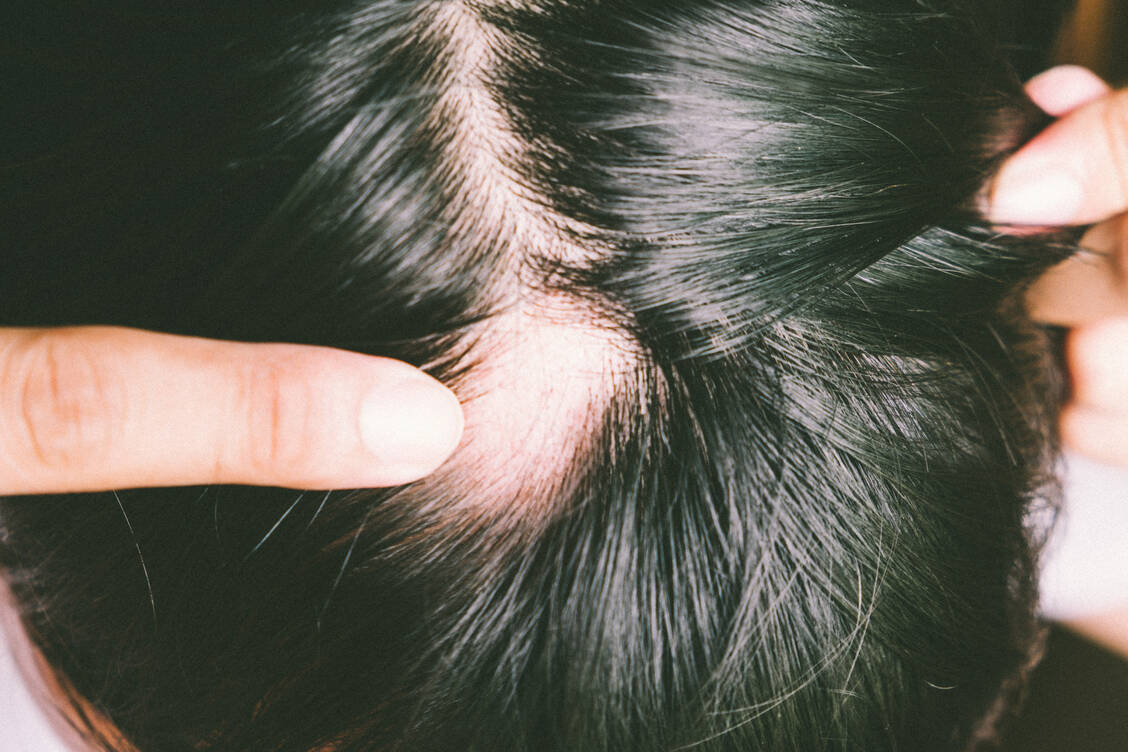 Bei Patientinnen und Patienten mit kreisrundem Haarausfall kommt es immer wieder zu kahlen Stellen bis hin zum vollständigen Verlust von Kopf- und Körperhaaren. Auch Augenbrauen und Wimpern können betroffen sein. / Foto: Getty Images/Wirul Kengthankan