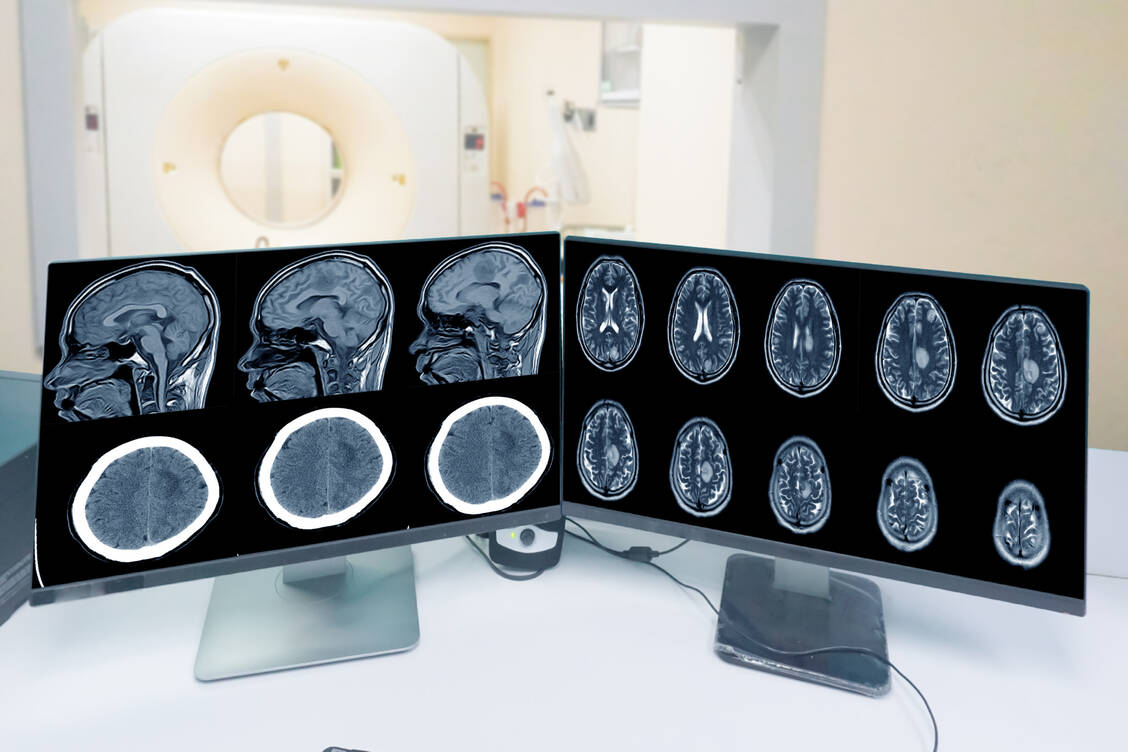 Meningeome sind Wucherungen der Hirnhäute, die in der Regel gutartig sind, in seltenen Fällen jedoch schwere Auswirkungen haben können. / Foto: Getty Images/Tonpor Kasa