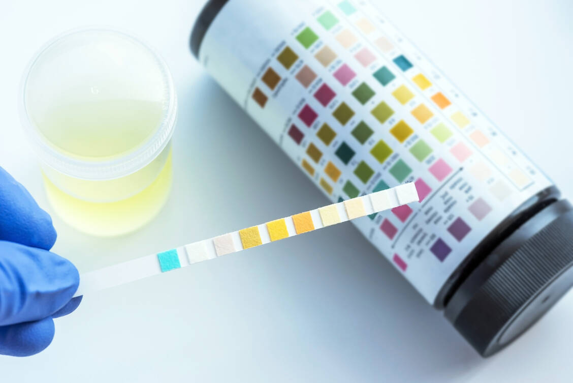 Mit dem Schnelltest werden gleich mehrere Werte im Urin bestimmt und per Farbskala semiquantitativ ausgewertet. / Foto: Adobe Stock/analysis121980