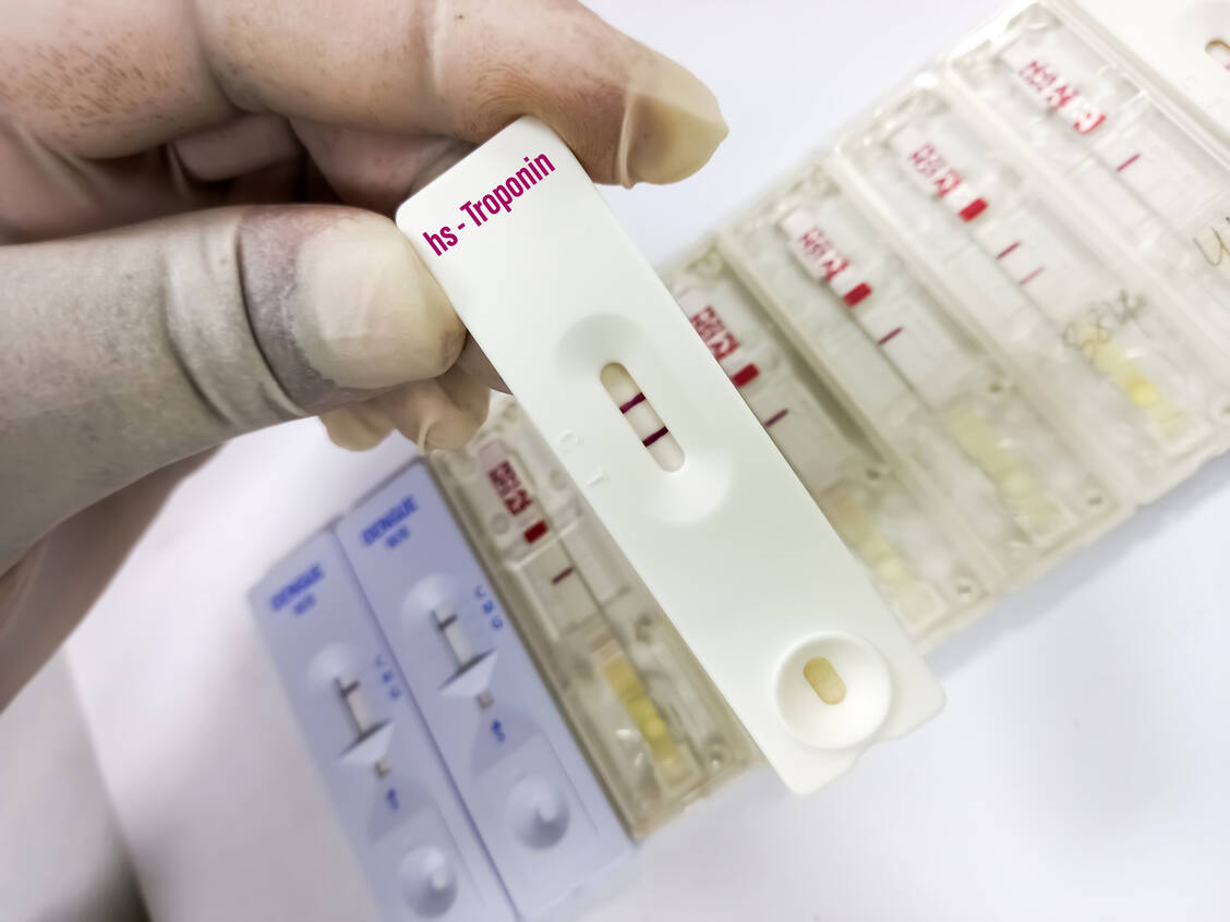 Das Protein Troponin wird aus geschädigten Herzmuskelzellen freigesetzt. Mit hochsensitiven Testmethoden lässt es sich bereits eine Stunde nach Infarktbeginn nachweisen. / Foto: Adobe Stock/MdBabul