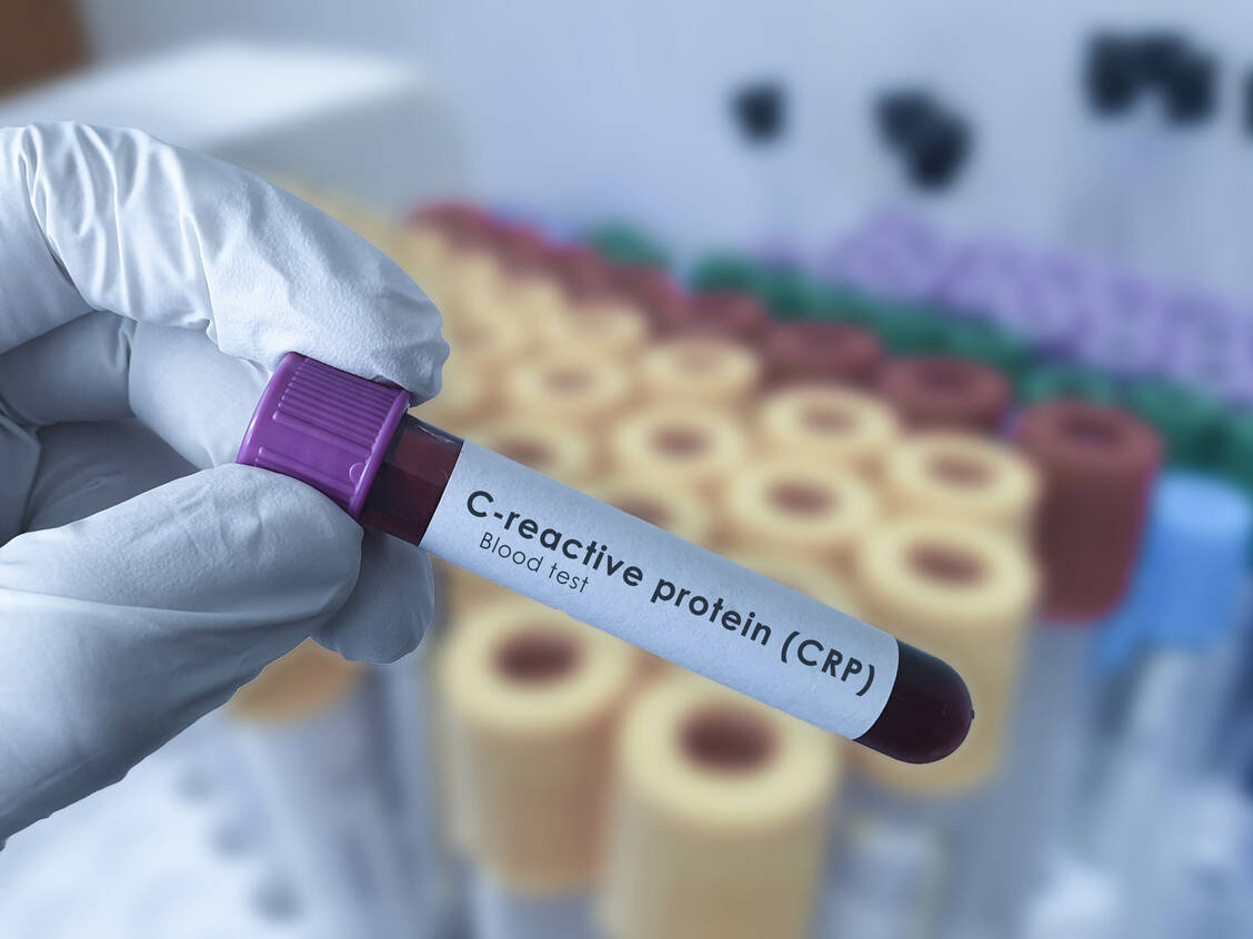Hohe Werte des Entzündungsmarkers CRP haben einer US-amerikanischen Untersuchung zufolge eine höhere Aussagekraft über das Herz-Kreislauf-Risiko von Frauen als das »schlechte« Cholesterol oder Lipoprotein(a).  / Foto: Adobe Stock/Soni's