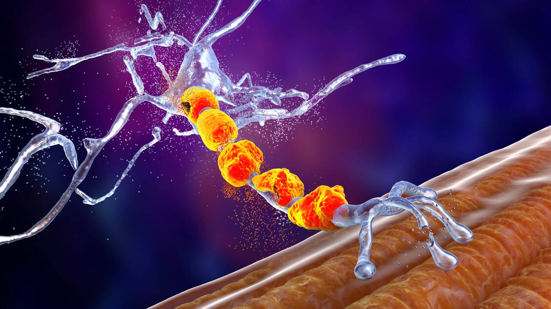Multiple Sklerose (MS) ist eine entzündliche Erkrankung des zentralen Nervensystems, bei der die Isolierschicht der Nervenzellen (Myelinscheide) und damit deren Reizweiterleitung Schaden nimmt. / Foto: Adobe Stock/Dr_Microbe