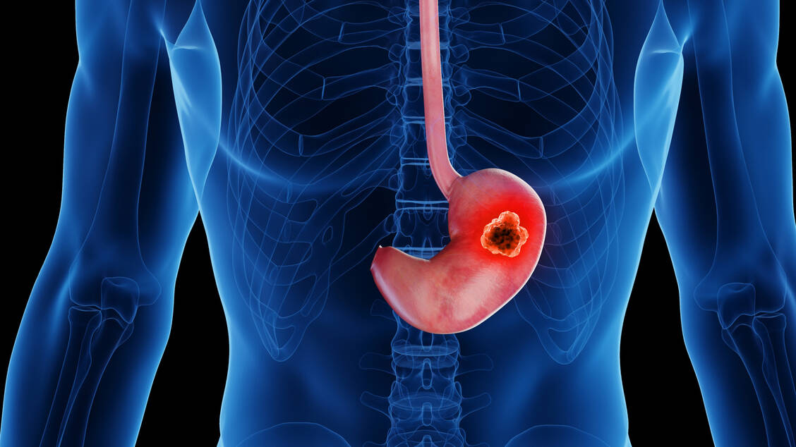 Bei Magenkrebs gibt es wie bei vielen anderen Krebserkrankungen einen Bedarf an neuen therapeutischen Optionen, die das Fortschreiten der Krankheit verlangsamen und das Leben verlängern können. / Foto: Adobe Stock/Sebastian Kaulitzki
