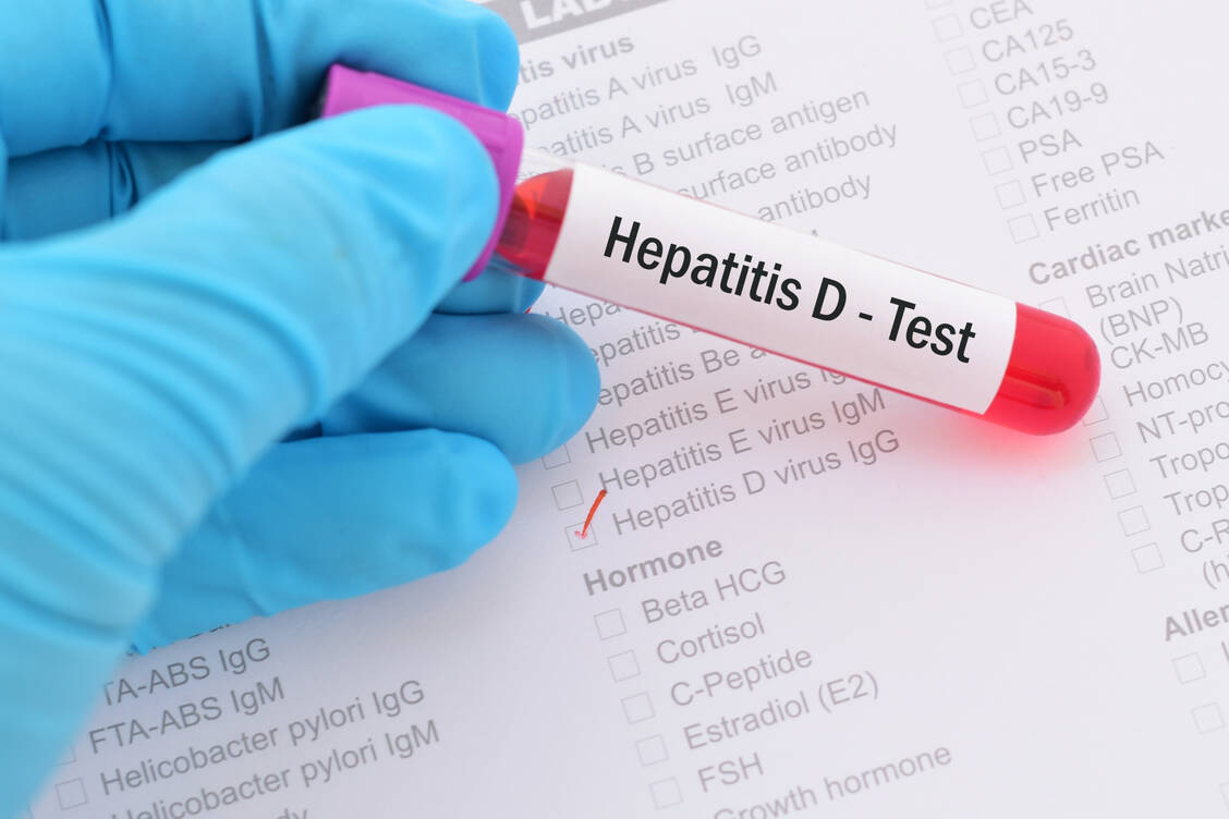Die chronische Hepatitis D gilt bislang als schwer behandelbar. Eine Infektion mit Hepatitis-D-Viren geht dabei übrigens immer mit einer Hepatitis-B-Koinfektion einher. / Foto: Adobe Stock/jarun011
