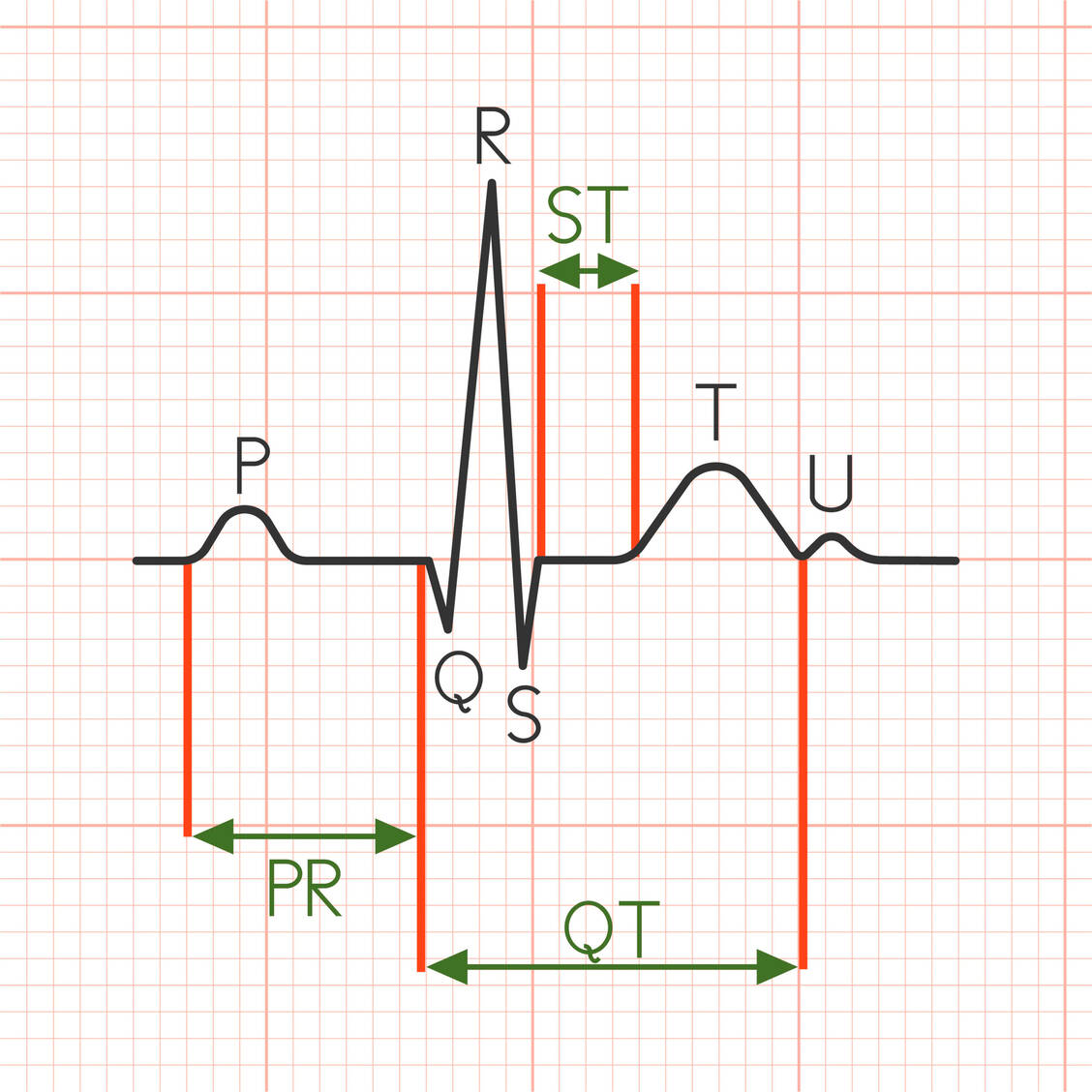 Die QT-Zeit beschreibt die Erregungsdauer der Herzkammer, von der Q-Zacke bis zur T-Welle im EKG. / Foto: Adobe Stock/lukpedclub