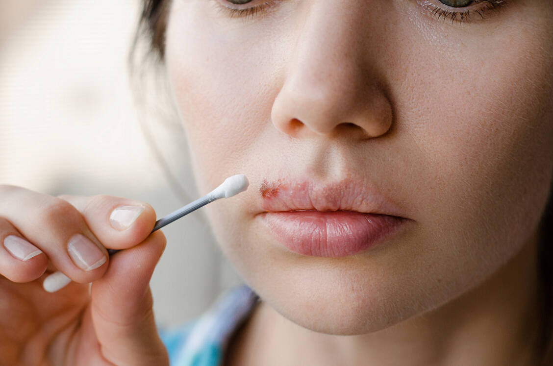 Zum Auftragen der Cremes gegen Lippenherpes empfiehlt es sich, ein Wattestäbchen zu benutzen. / Foto: Adobe Stock/domaskina