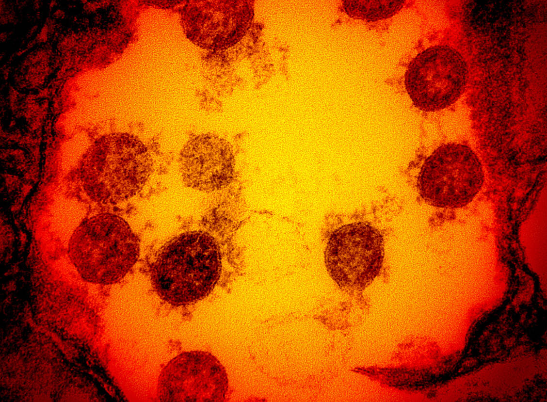 SARS-CoV-2 im Elektronenmikroskop / Foto: NIH-NIAID