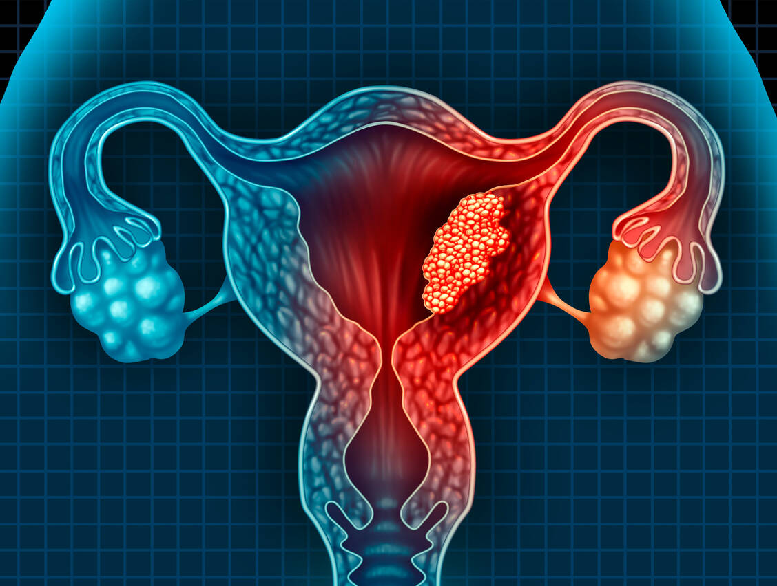 Gebärmutterkrebs ist der häufigste Tumor der weiblichen Geschlechtsorgane. / Foto: Adobe Stock/freshidea