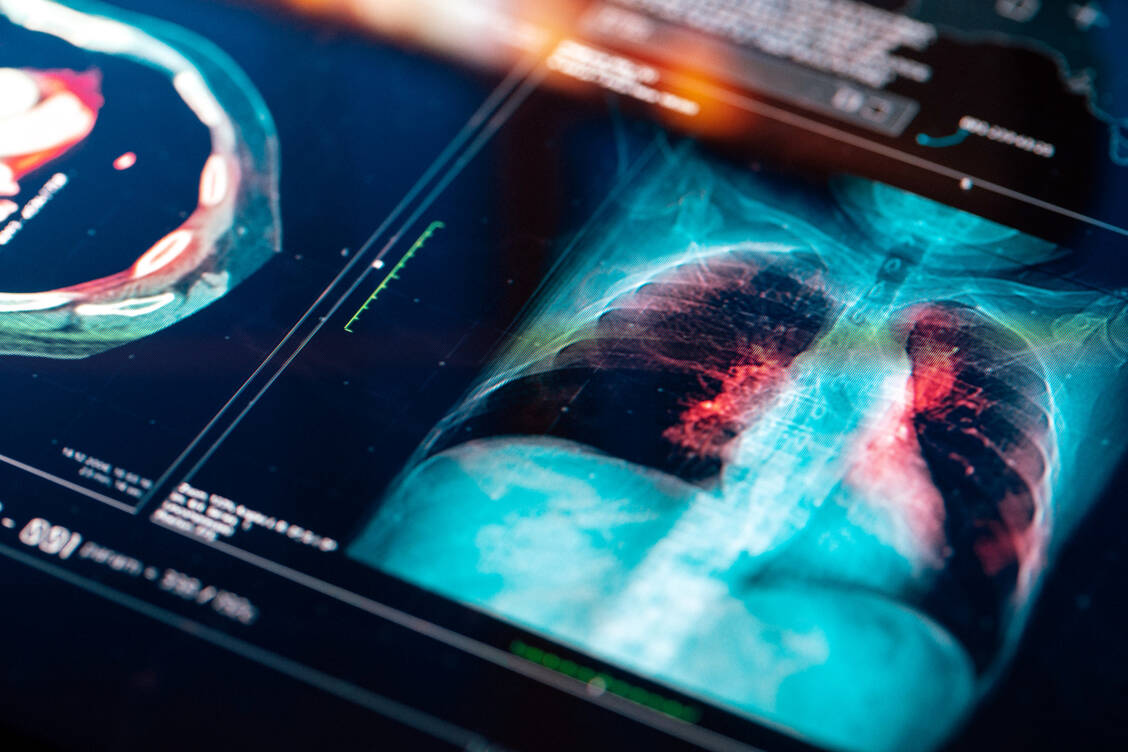 Das fortgeschrittene kleinzellige Lungenkarzinom ist mit einer frühen Metastasierung und einer extrem schlechten Prognose verbunden. Mit Serplulimab könnte es eine weitere Therapieoption geben. / © Getty Images/da-kuk