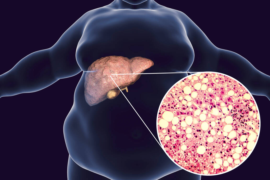 Bei einer Fettleber befindet sich zuviel Fett in den Leberzellen. Das kann auf Dauer zu Fibrose, Zirrhose und Leberkrebs führen. / Foto: Adobe Stock/Kateryna_Kon
