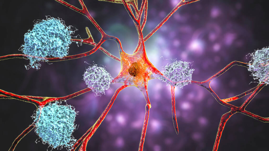 Amyloid-β im Gehirn scheint über die Kinase p38 eine Neuroinflammation zu verstärken. Das Enzym könnte eventuell ein neues Therapie in der Alzheimertherapie sein.  / Foto: Adobe Stock/Dr_Microbe