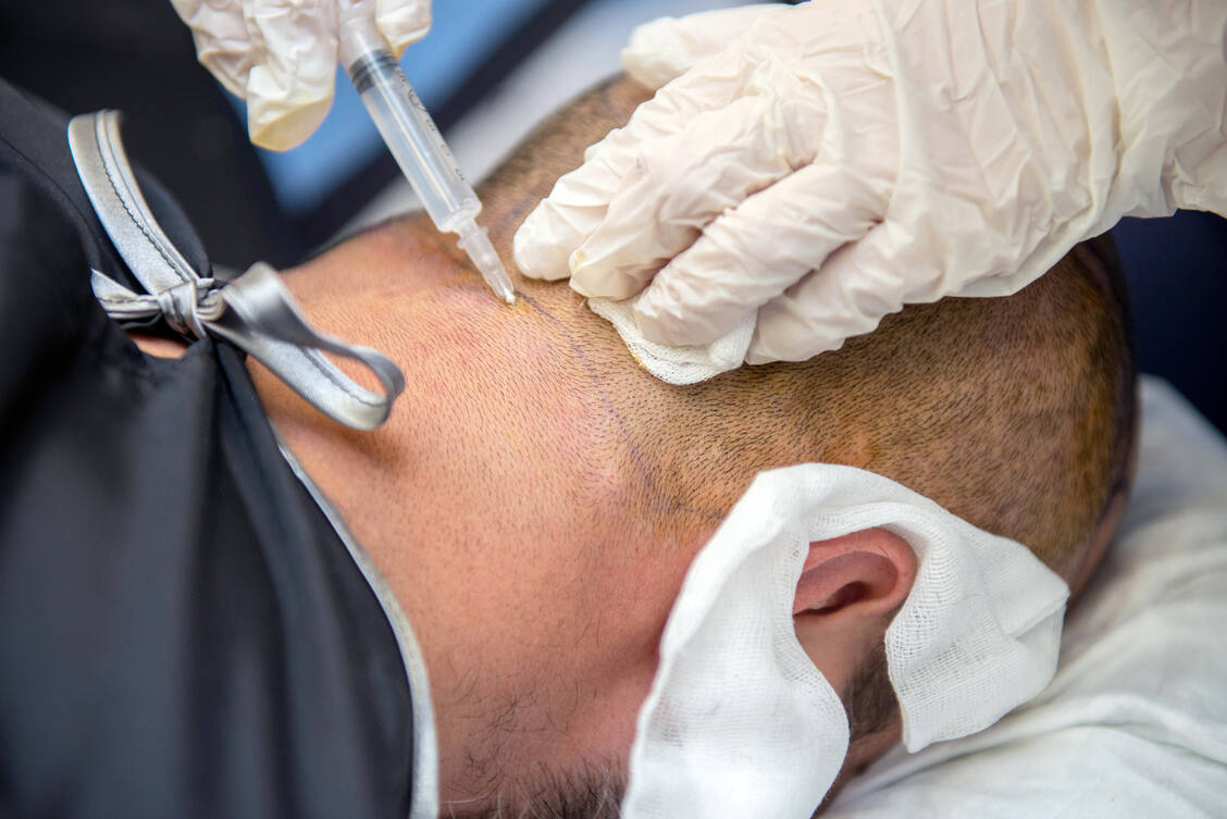 Haartransplantationen können haarlose Kopfareale bis zu einem gewissen Grad wieder füllen. / Foto: Adobe Stock/tolga
