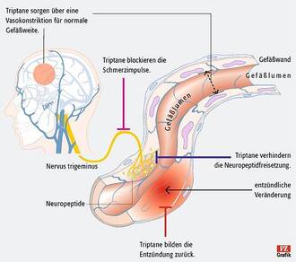 Triptane hemmen die Ausschüttung von am Entzündungs- und Schmerzgeschehen beteiligten Neuro­peptiden und verengen pathologisch erweiterte Blutgefäße im Gehirn. (Anklicken zum Vergrößern)