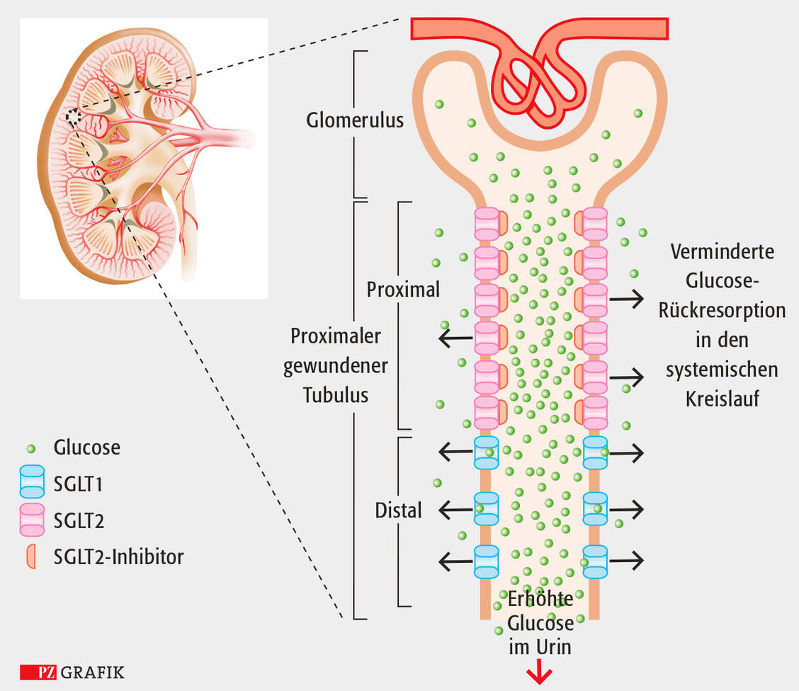 Der Wirkmechanismus von SGLT-2-Hemmern funktioniert auch bei Typ-1-Diabetes. Die Wirkstoffe blockieren den SGLT-2-Transporter und­ reduzieren dadurch die Rückresorption von Glucose in den proximalen Tubulus. In der Folge wird mehr Glucose mit dem Harn ausgeschieden / Foto: PZ