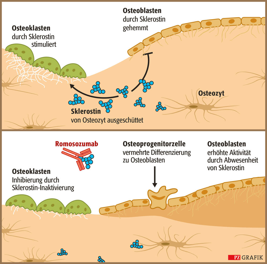Sklerostin wird von den Osteozyten innerhalb reifer Knochenmatrix ausgeschüttet (oben). Es hat zwei Hauptaufgaben: Stimulierung von Osteoklasten, was zu einer erhöhten Knochenresorption führt, und Hemmung von Osteoblasten, was zu einer verminderten Knochenneubildung führt. Romosozumab fördert die Knochenbildung durch Bindung und Inhibition des Proteins Sklerostin (unten). Dadurch werden Saumzellen aktiviert, reife Osteoblasten zur Bildung von Knochenmatrix stimuliert und die Differenzierung neuer Osteoblasten aus Knochenvorläuferzellen (Osteoprogenitorzellen) angekurbelt. (Quelle: UCB Pharma) / Foto: PZ Grafik/Stephan Spitzer