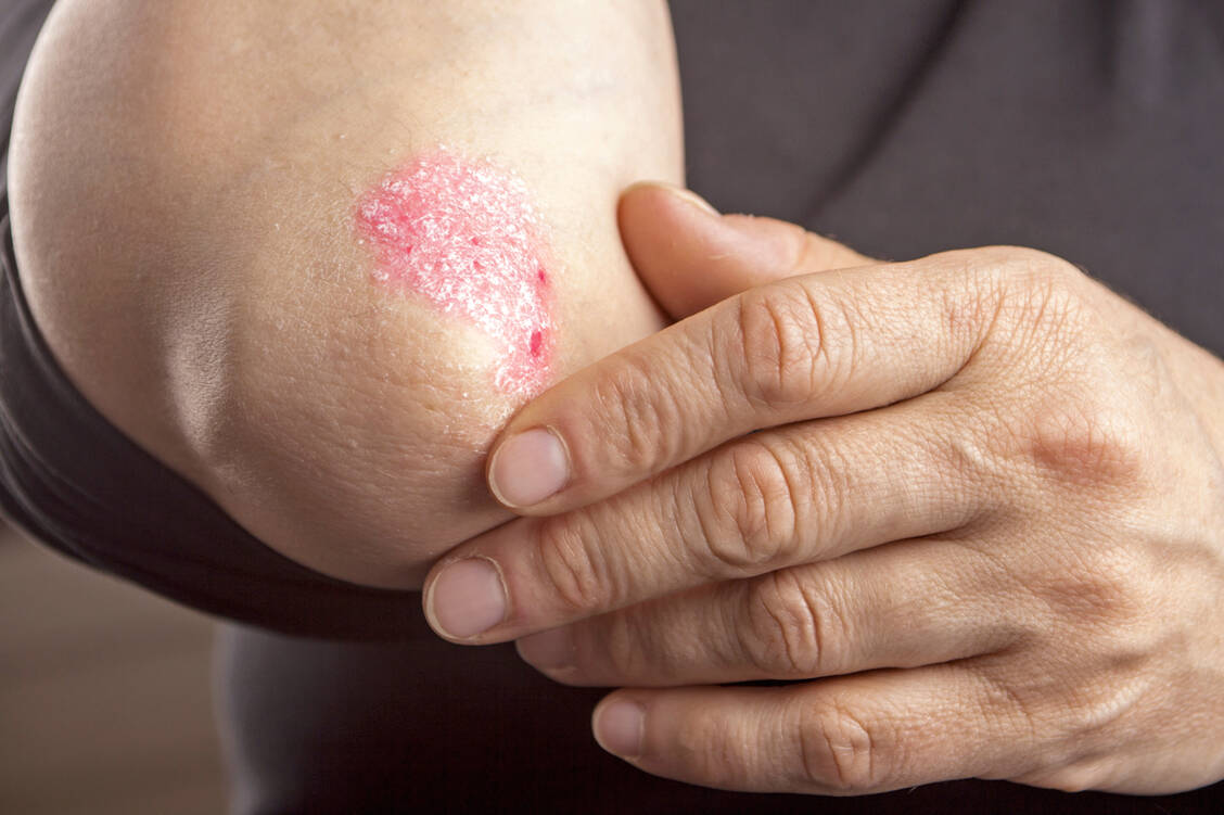 Wie die meisten Hautkrankheiten ist Psoriasis mit einem hohen Leidensdruck der Patienten verbunden. Mit modernen Therapeutika ist jedoch eine gute Einstellung fast immer möglich. / Foto: Shutterstock/Hriana