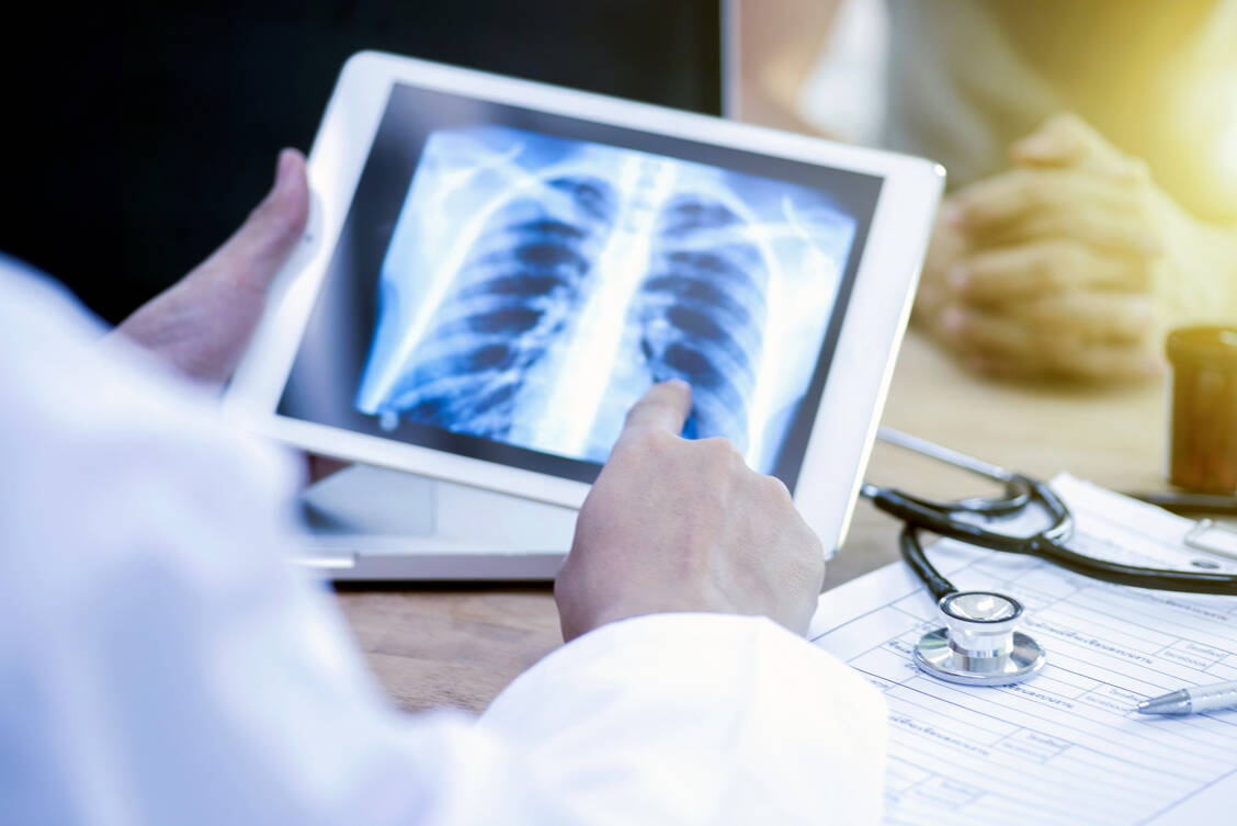 Ein kleinzelliges Lungenkarzinom ist ein sehr aggressiver Tumor und wird oft erst im fortgeschrittenen Stadium entdeckt. Die Prognose der Patienten ist schlecht.  / © Getty Images/boonchai wedmakawand