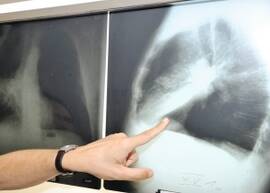 Lungenkrebs wird häufig erst spät entdeckt und ist dann in der Regel nicht mehr heilbar.
<p class="fotonachweis">Foto: dpa</p>