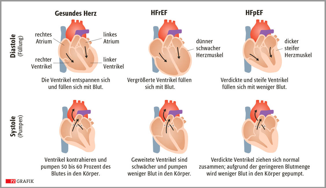 Abbildung 2: Pathophysiologie der chronischen Herzinsuffizienz; mod nach www.merckmanuals.com/home/heart-and-blood-vessel-
disorders/heart-failure/heart-failure-hf; HFrEF: Herzinsuffizienz mit reduzierter Ejektionsfraktion; HFpEF: Herzinsuffizienz mit erhaltener Ejektionsfraktion / Foto: PZ/Pfeifer