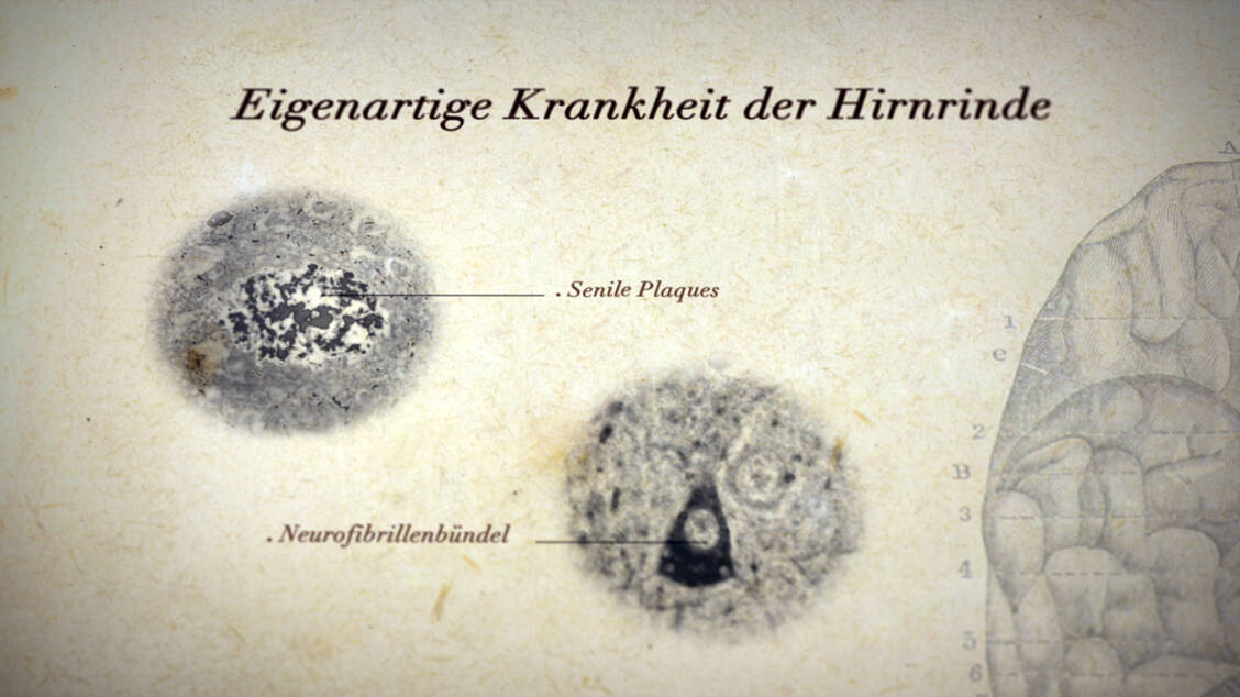Amyloid-Plaques und Neurofibrillen-Bündel: Der deutsche Neurologe Alois Alzheimer beschrieb 1906 als Erster die charakteristischen Veränderungen im Gehirn seiner verstorbenen Patientin Auguste Deter. / © Alzheimer Forschung Initiative