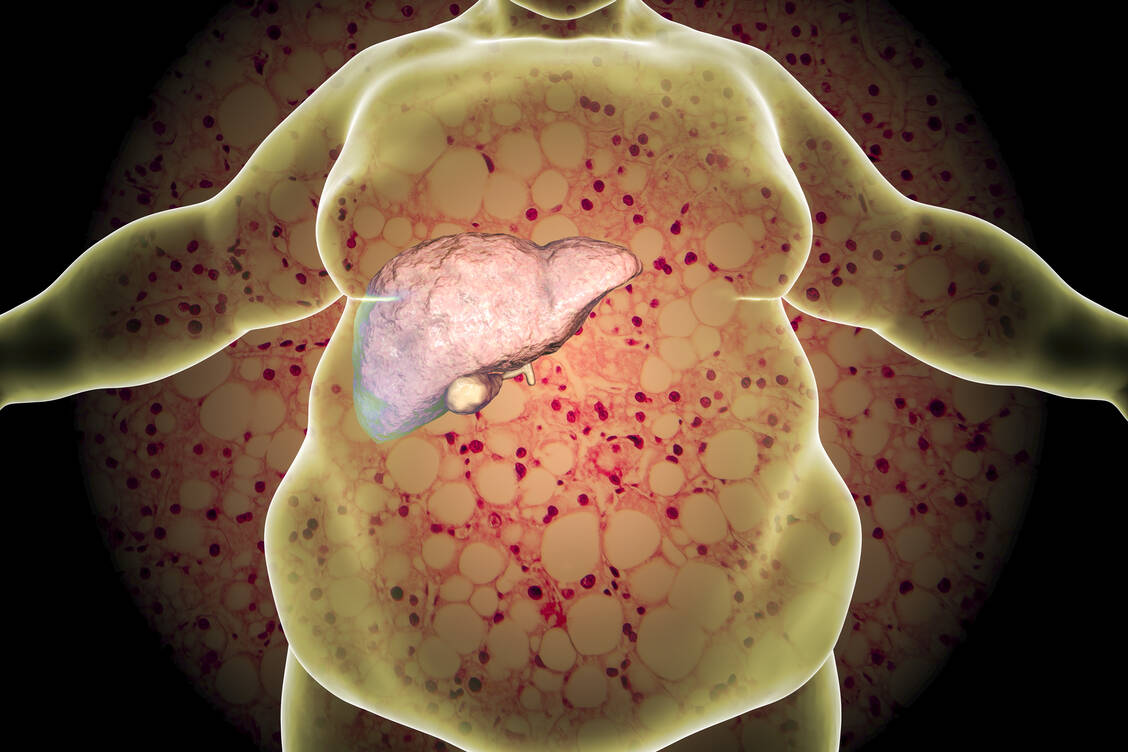 Bei einer Fettleber wird übermäßig viel Fett in den Hepatozyten eingelagert. Es kommt zu Entzündungsreaktionen (Steatohepatitis). / Foto: Adobe Stock/Kateryna_Kon