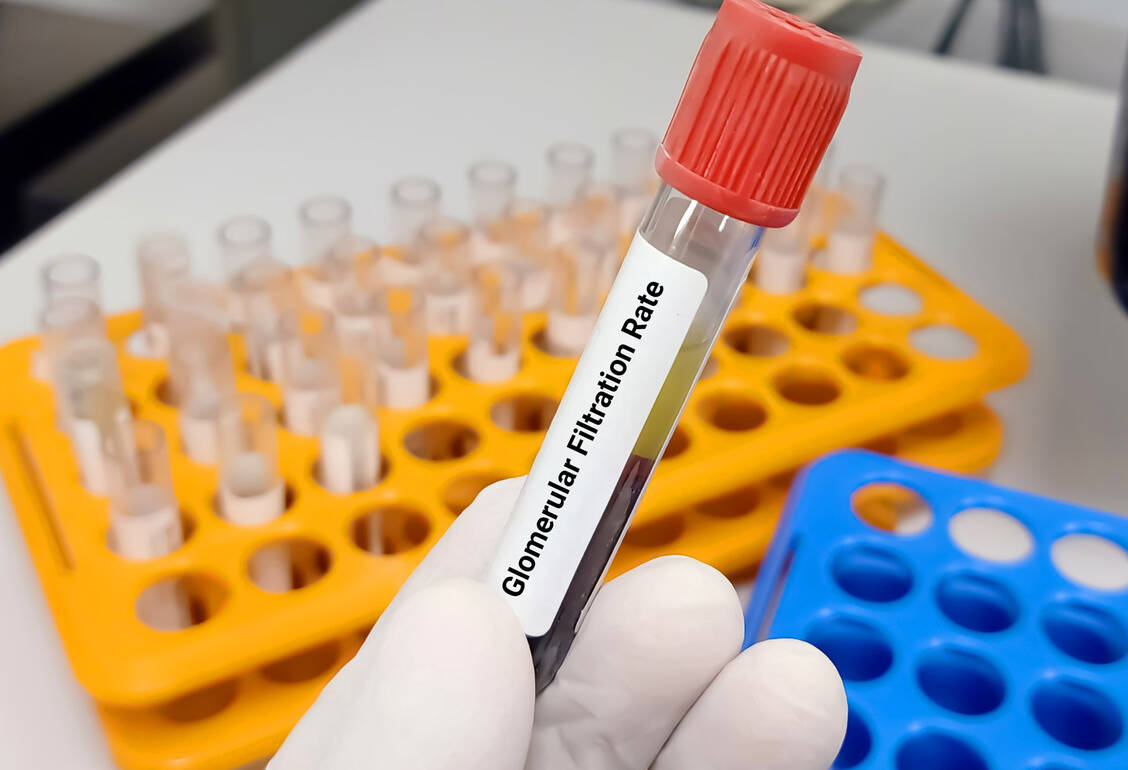 Eine Albuminurie ist oft das erste Zeichen eines chronischen Nierenschadens. Wer nur auf die glomeruläre Filtrationsleistung schaut, übersieht das frühe Stadium mitunter.  / © Adobe Stock/Creative Vault