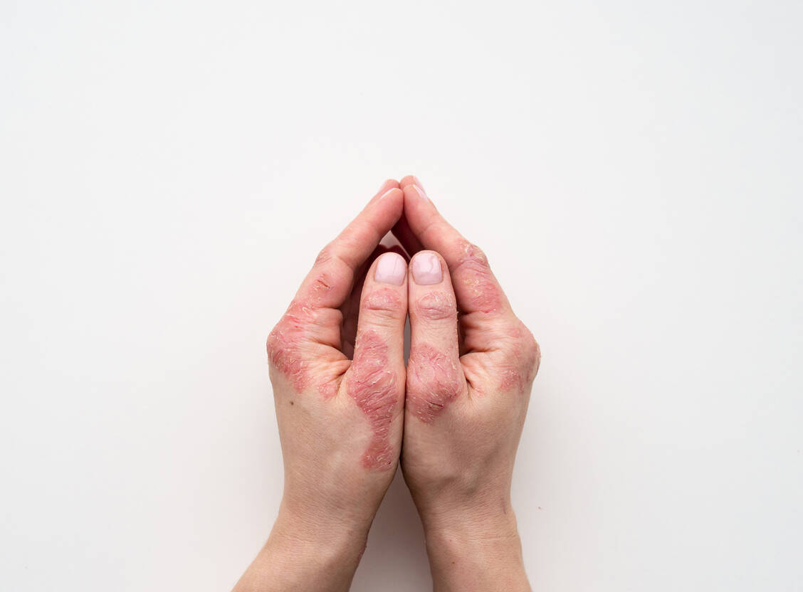 Rötliche, schuppende Hautveränderungen sind typisch für die Psoriasis.  / Foto: Adobe Stock/IIIRusya