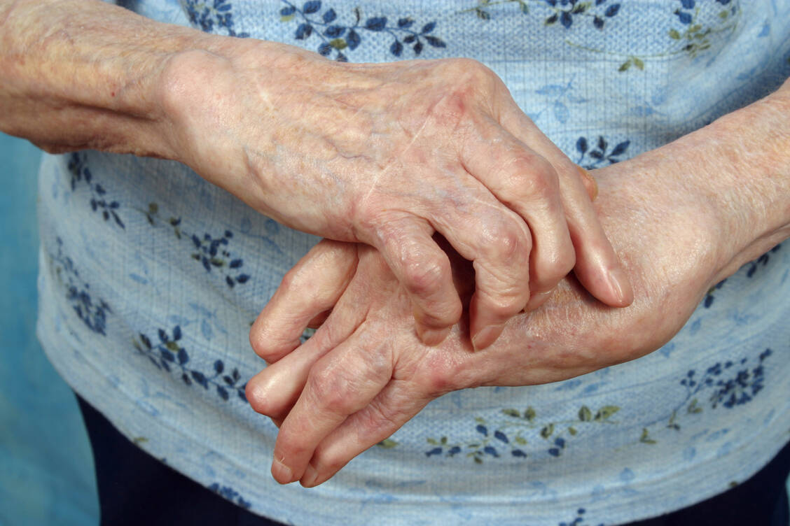 Fehlende Toleranz: Bei Autoimmunerkrankungen wie der rheumatoiden Arthritis binden autoreaktive Antikörper an körpereigene Strukturen und führen zur Entzündung. / Foto: Getty Images/Stan Rohrer