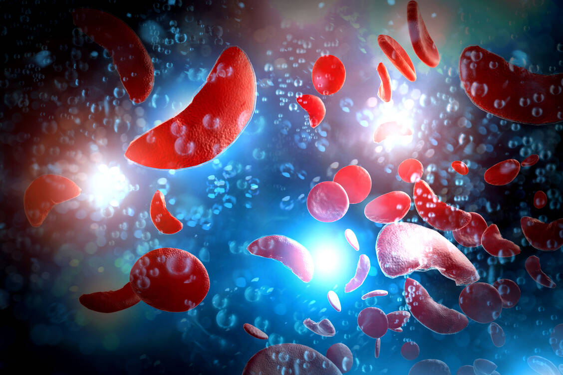 Das anormale Hämoglobin S bildet Fibrillen, die die Erythrozyten in die namensgebende Sichelform zwingen. / © Shutterstock/Ezume Images