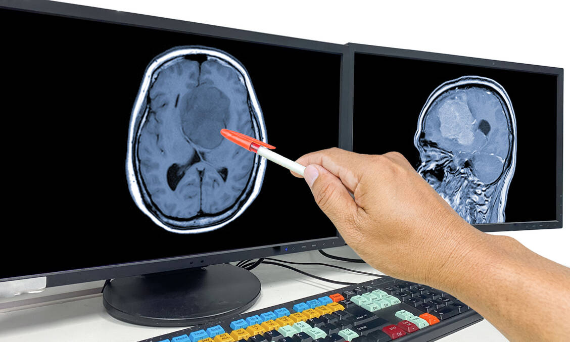 Das Glioblastom ist ein bösartiger Hirntumor mit einer mittleren Überlebenszeit von etwa 14 bis 15 Monaten ab Diagnosestellung. / Foto: Adobe Stock/Richman Photo