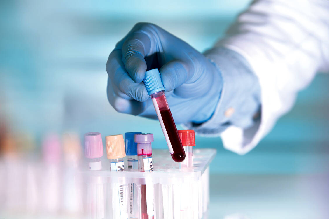 Im Blut lassen sich Überreste abgestorbener Nervenzellen im Gehirn nachweisen. / Foto: Shutterstock/angellodeco