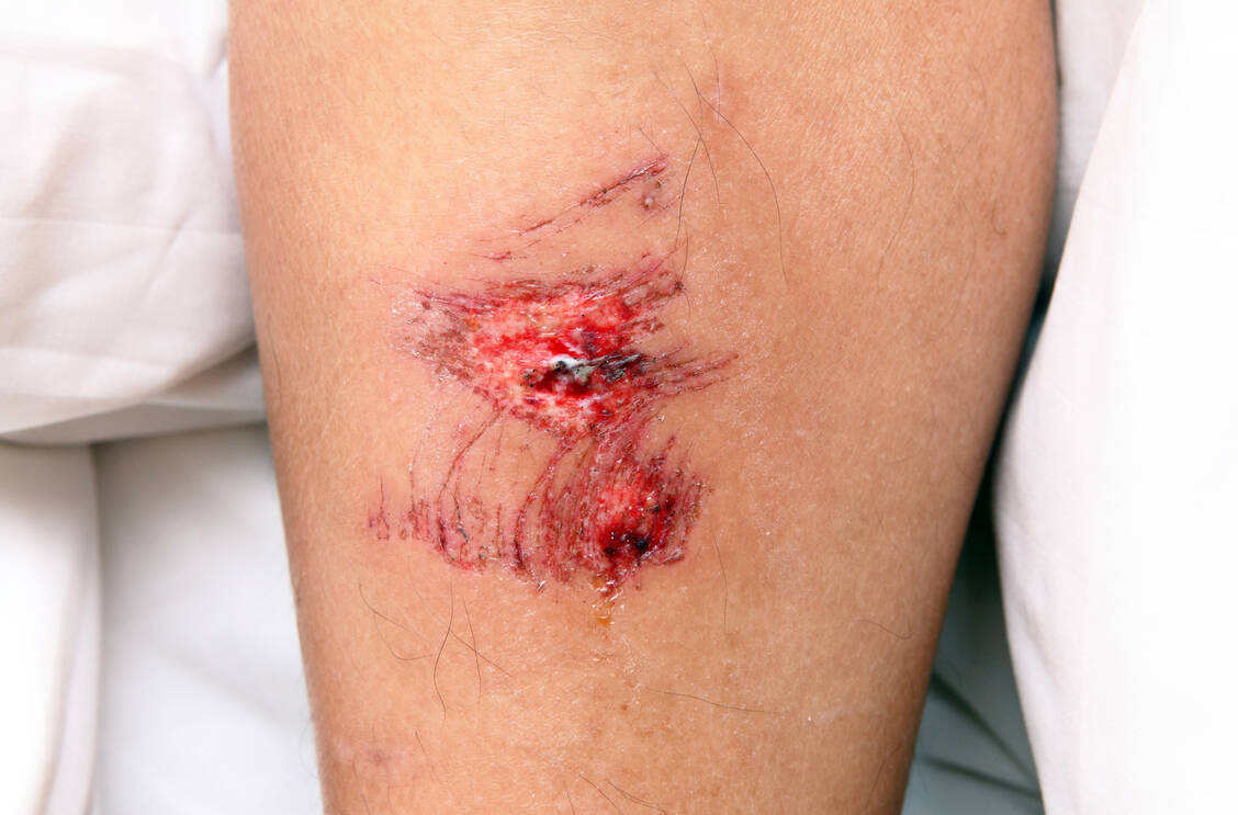 Wie gerinnt das Blut eigentlich? Die Vorstellungen zur Gerinnungskaskade haben sich in den letzten Jahren geändert. / Foto: Adobe Stock/leungchopan