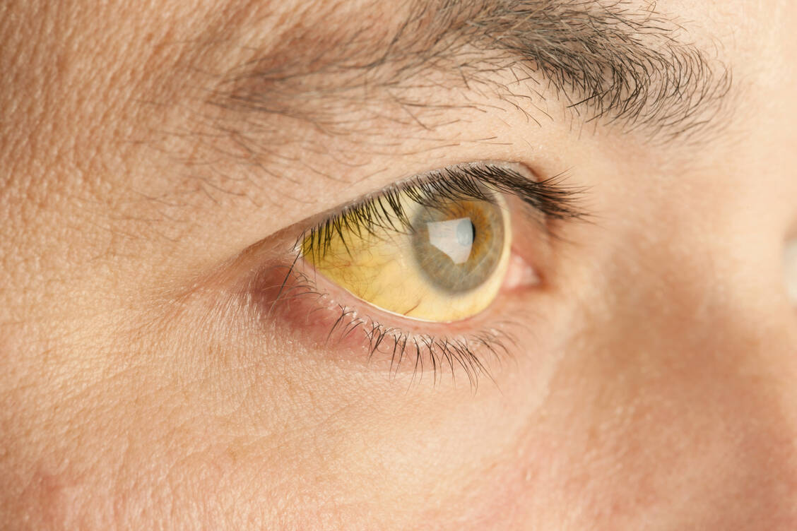 Eine Gelbsucht zeigt Probleme mit Leber und Galle an. / Foto: Getty Images/MediaProduction