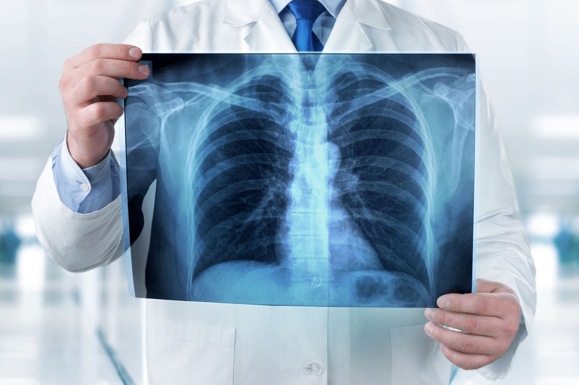 Ein Lungenkrebs-Screening unter Einsatz der Niedrigdosis-Computertomografie (Low-Dose-CT) könnte (ehemals) starken Rauchern mehr nutzen als schaden. / Foto: Adobe Stock/BillionPhotos.com