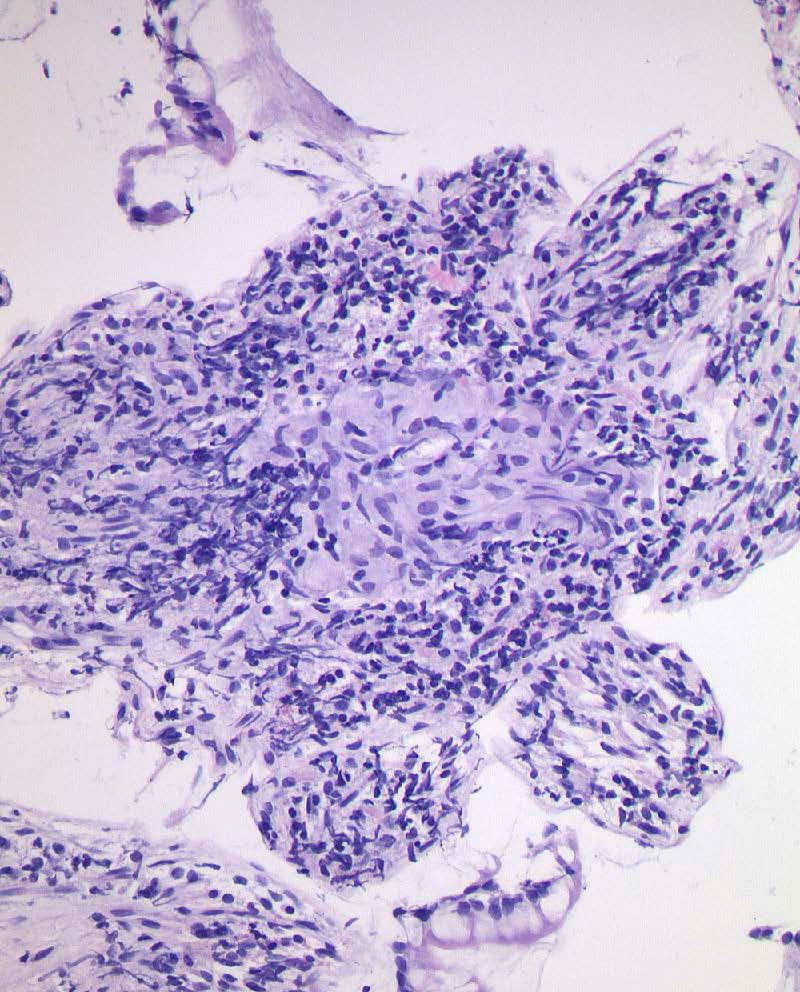 Abbildung: Histologische Aufnahme der Darmschleimhaut eines Crohn-Patienten mit den typischen granulomatösen Veränderungen (dunkel eingefärbt) / Foto: Dr. Sheridan, Institut für Pathologie, Justus-Liebig-Universität Gießen