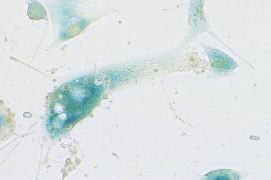 Zellen der menschlichen Nasenschleimhaut, die infolge einer SARS-CoV-2-Infektion das Seneszenz-Programm gestartet haben, unter dem Mikroskop. / Foto: Charité/Soyoung Lee